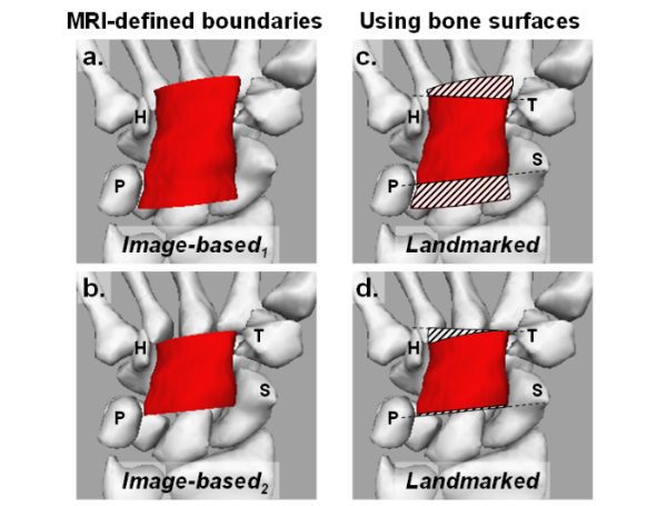 The Effect of Landmarks and Bone Motion on Posture-Related Changes in ...